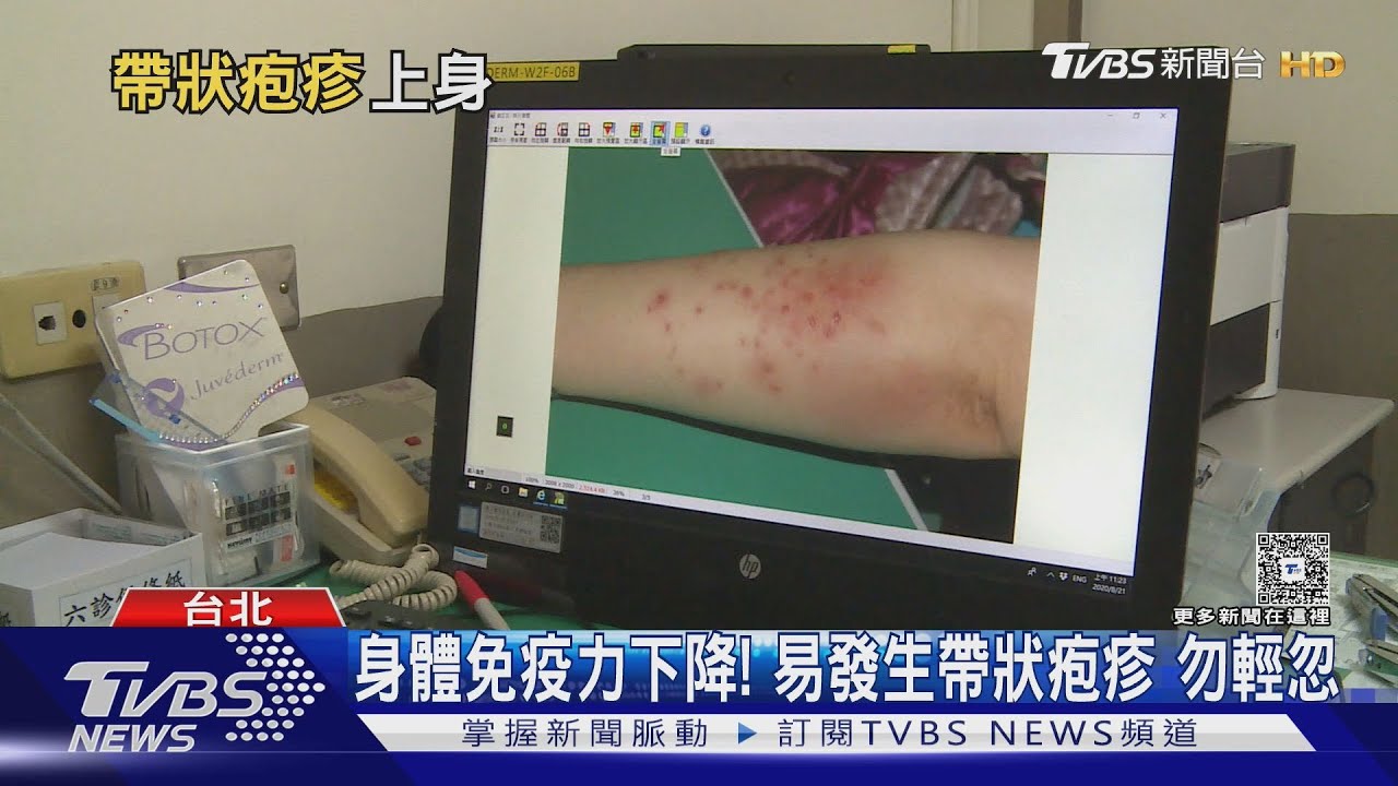 皮蛇上身痛到像刀割!帶狀疱疹恐終生神經痛 醫師:別做這件事!｜十點不一樣20250811 @TVBSNEWS01