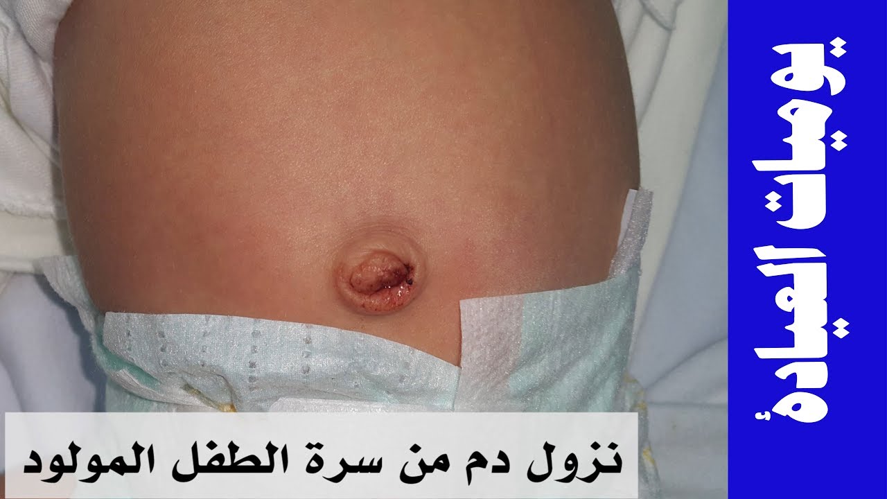 نزول دم من سرة المولود والعناية بالسرة | يوميات العيادة