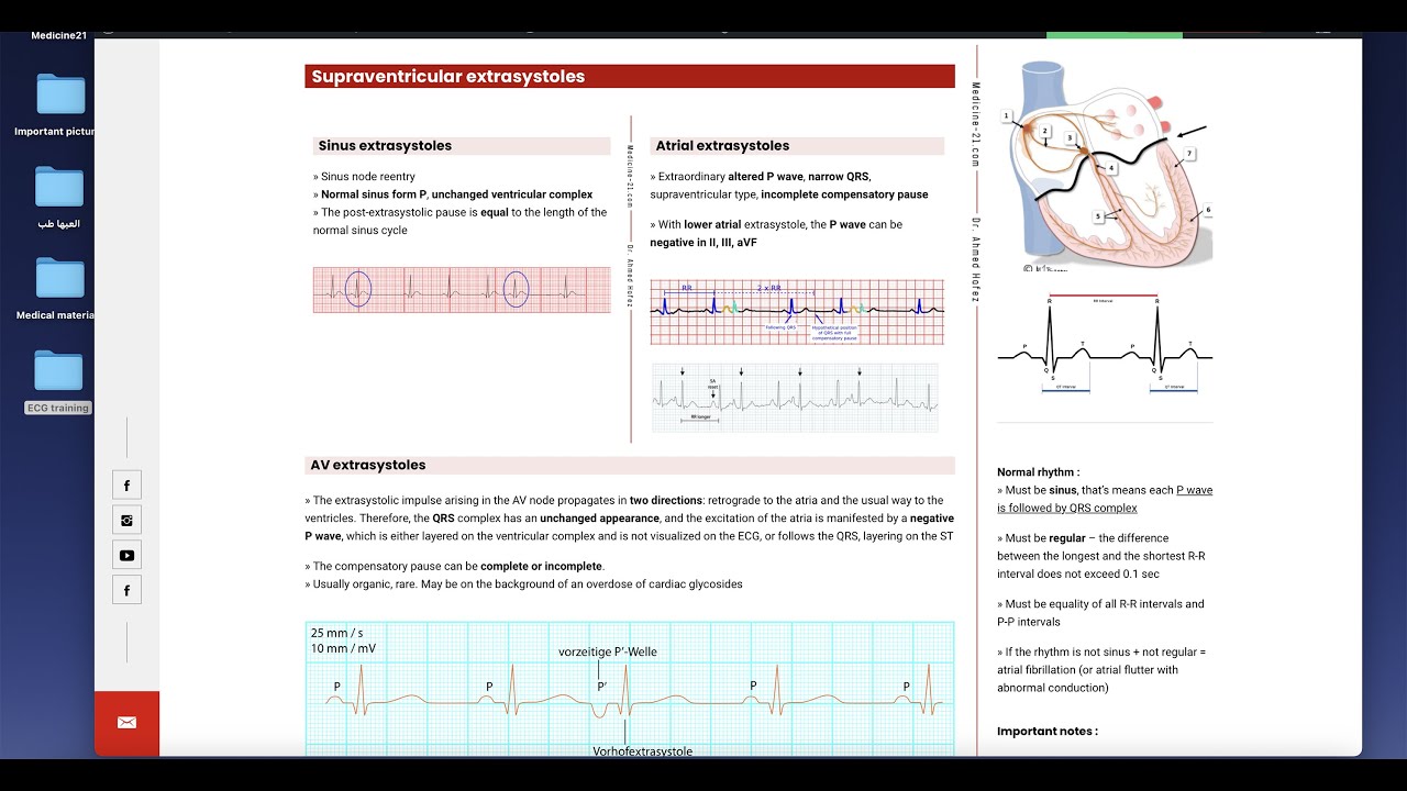 Extrasystole arrhythmias