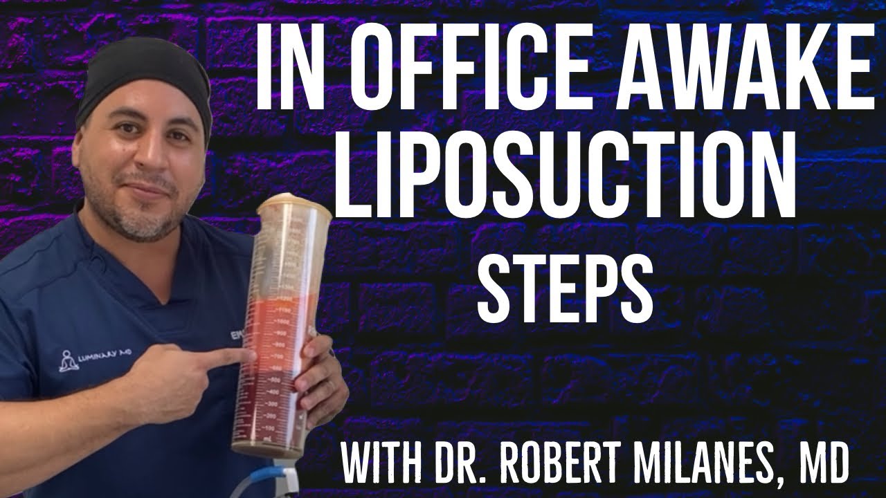 In Office Awake Liposuction Steps | Dr. Robert Milanes,MD