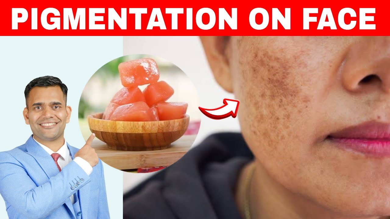 How To Remove Pigmentation On Face at Home Naturally - Dr. Vivek Joshi