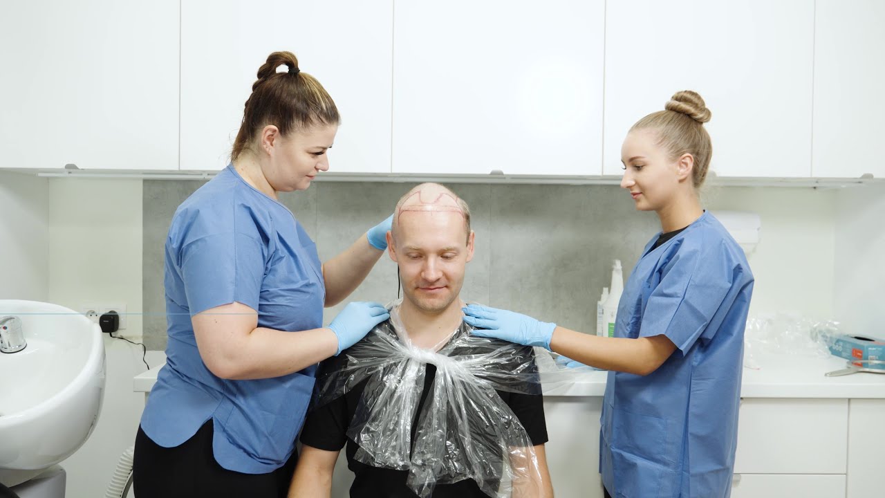 Jak wygląda zabieg przeszczepu włosów metodą FUE w Aestetic Clinic?