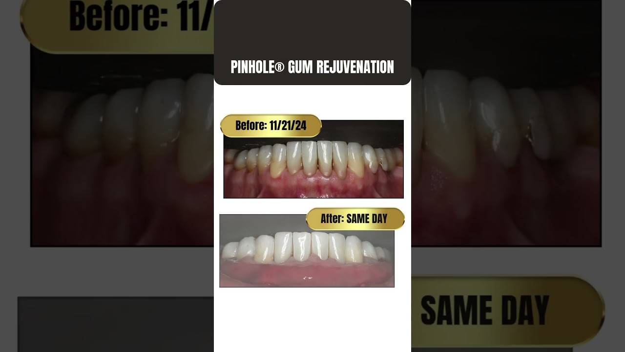 Same-Day Transformation! ✨Witness the IMMEDIATE results of the Pinhole&reg; Gum Rejuvenation procedure!