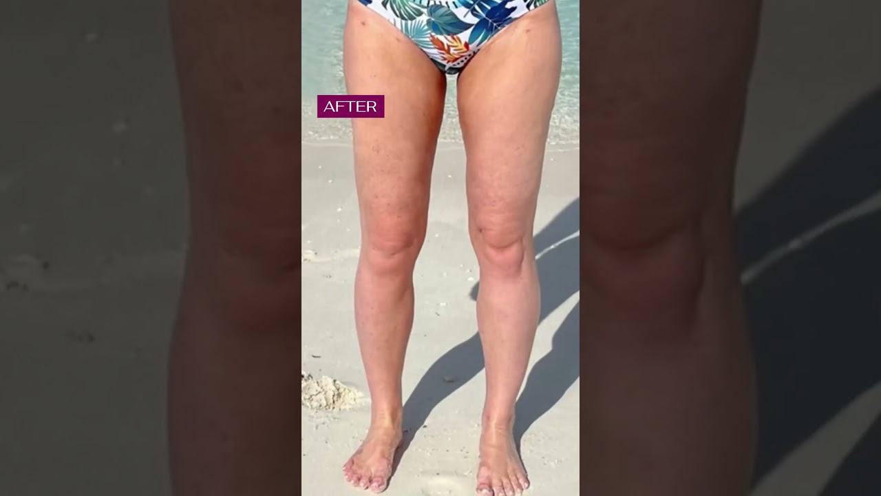 Stunning Transformations | Lipedema Leg Liposuction | Artlipo | Expert Dr. Thomas Su