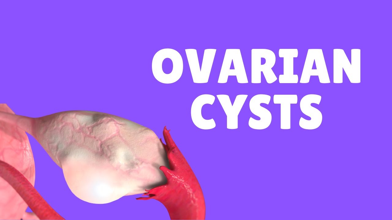 Ovarian Cysts | Los Angeles | Dr. Michael Tahery