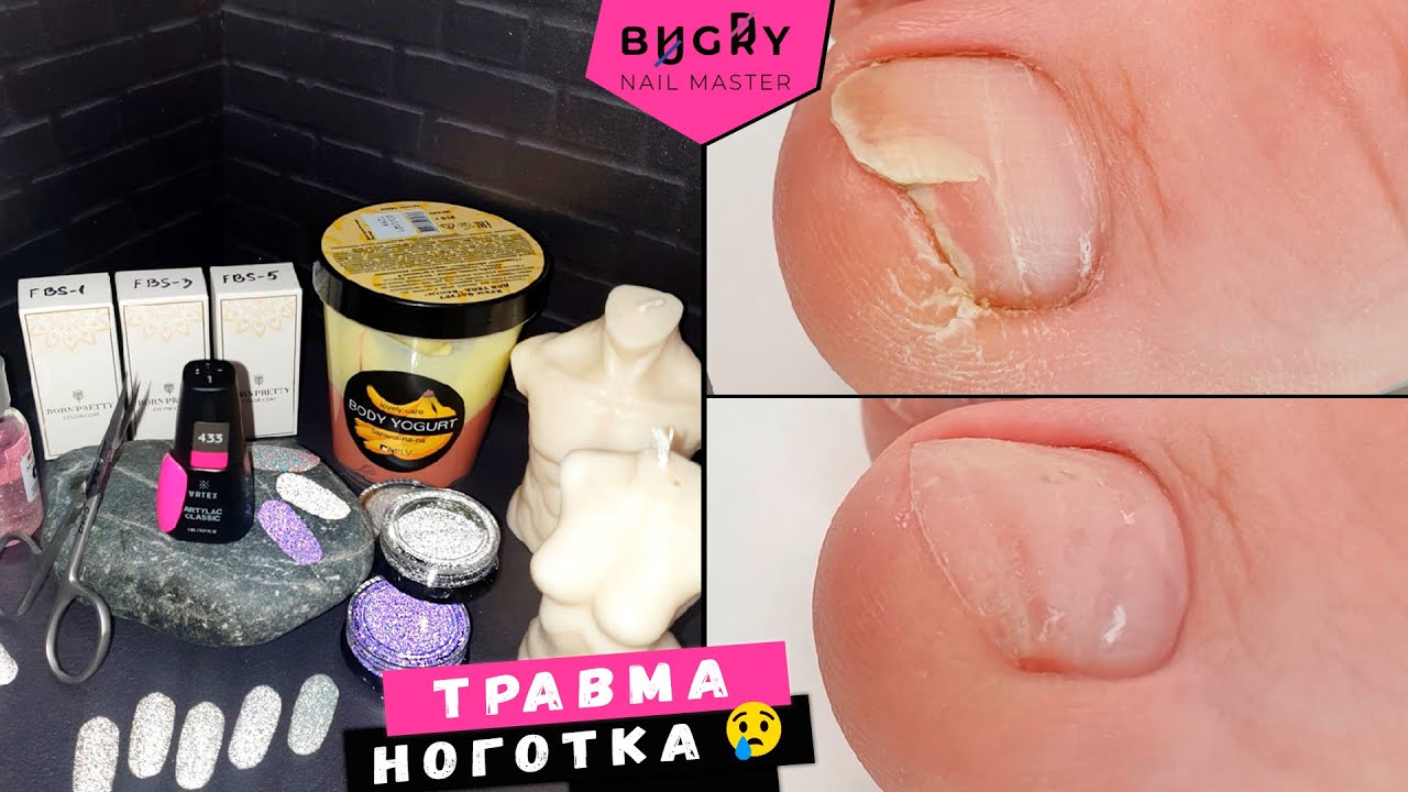 ПРОТЕЗИРОВАНИЕ травмированного НОГТЯ / РАСПАКОВКА НОВИНОК для НОГТЕЙ #ТатьянаБугрий