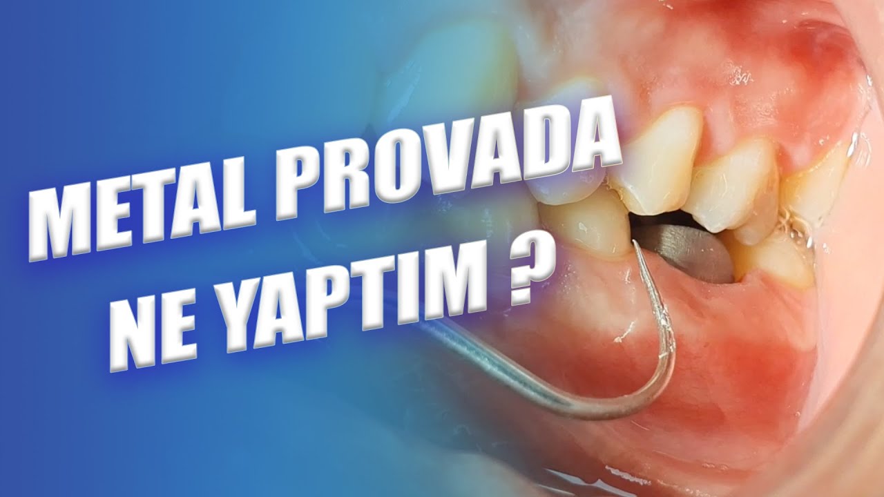 Metal Prova Sırasında Problem Çözümü - Nasıl Yapılır?