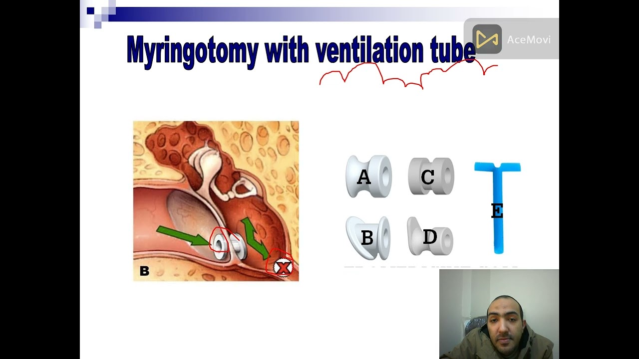 ear operation   sound