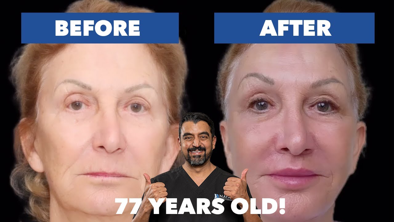 77 Year Old Facelift with AMAZING Results