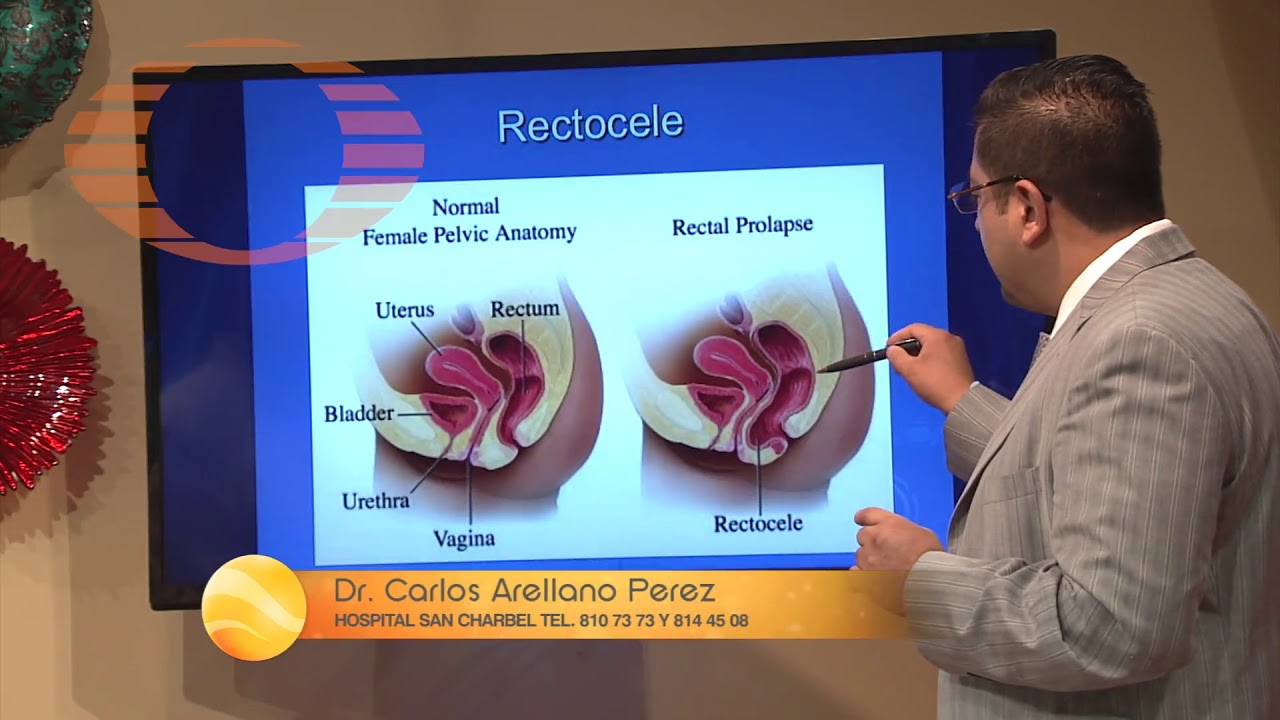 DR ARELLANO Rectocele