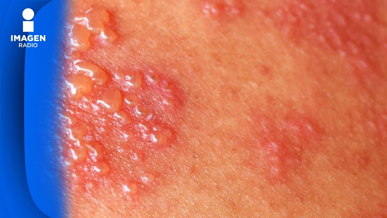 ¿Qué es y quién puede padecer herpes zóster?