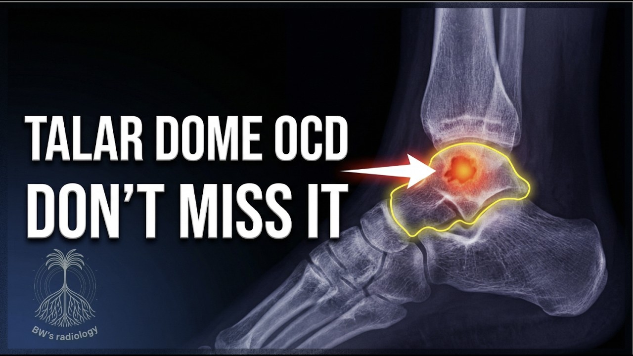 Ankle - Osteochondritis dissecans