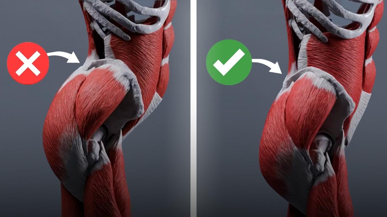 The Truth About Fixing Anterior Pelvic Tilt - Why You’ve Been Misled