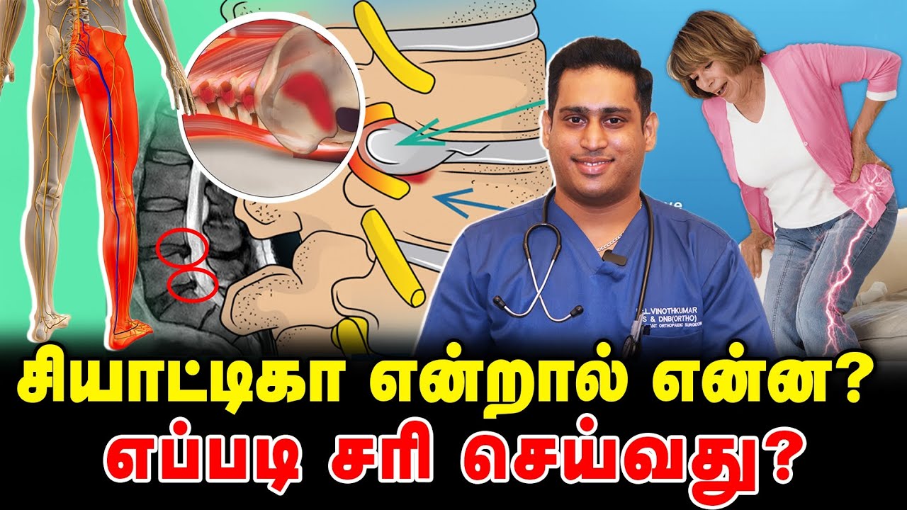 சியாட்டிகா என்றால் என்ன|Sciatica treatment|Sciatica relief without surgery|How to cure Sciatica