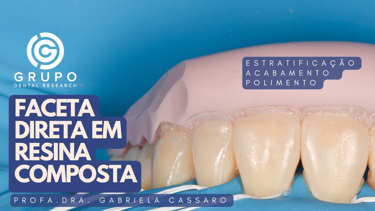 Técnica de Estratificação em Resina Composta, Escultura de Faceta / Lente em Resina com Naturalidade