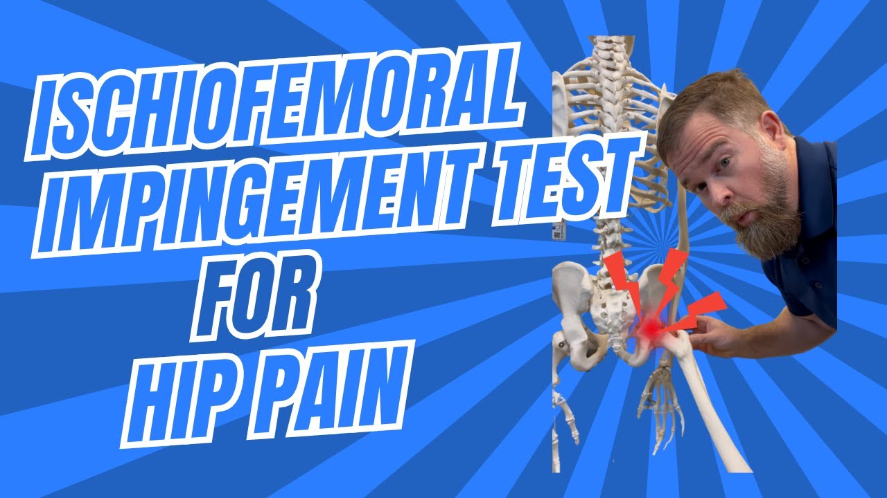 Ischiofemoral Impingement Test for Hip Pain