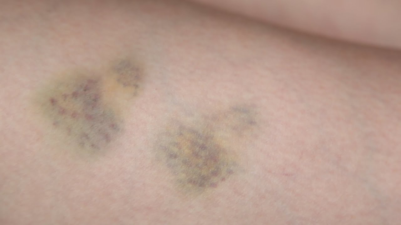 Bruise - SFX makeup Tutorial
