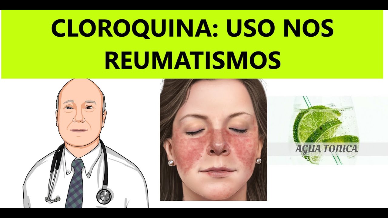 Cloroquina e hidroxicloroquina para reumatismos: quais os bons usos e efeitos indesejáveis.