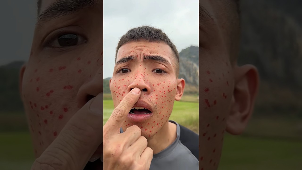 How I Used Cow Manure to Treat Acne in the Wild | Survival Story