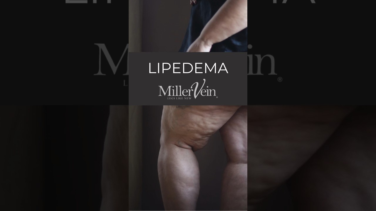 What is Lipedema?               #LipedemaAwareness #MillerVein #LegSwelling #VeinDisease