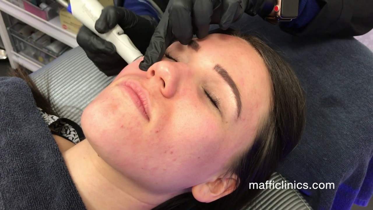 Maffi: Hydradermabrasion