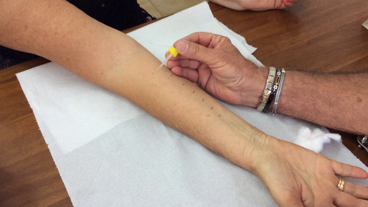 prove allergiche prick test