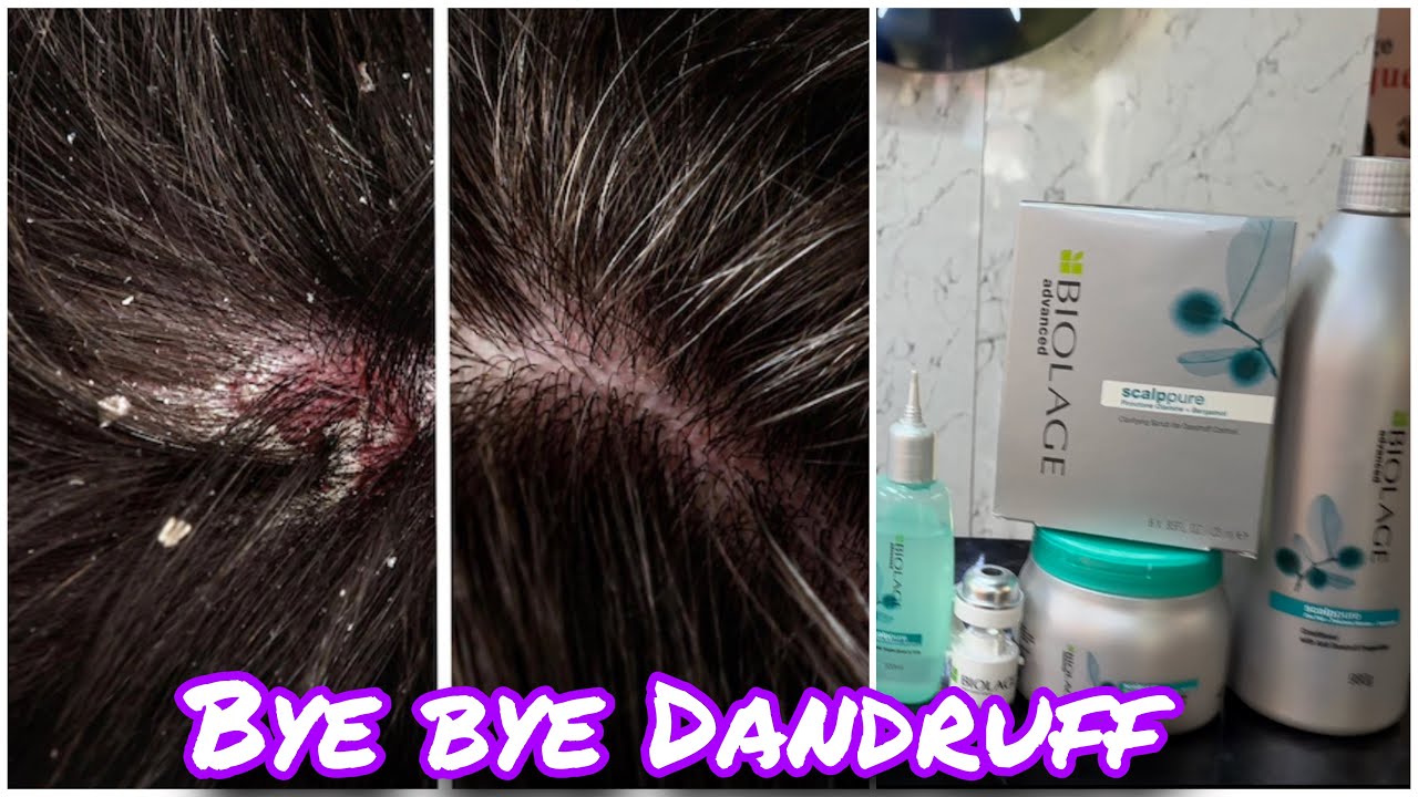 How to:Dandruff treatment करणे का आसान तरिका/At parlour/step by step/easy way/for beginners/Matrix