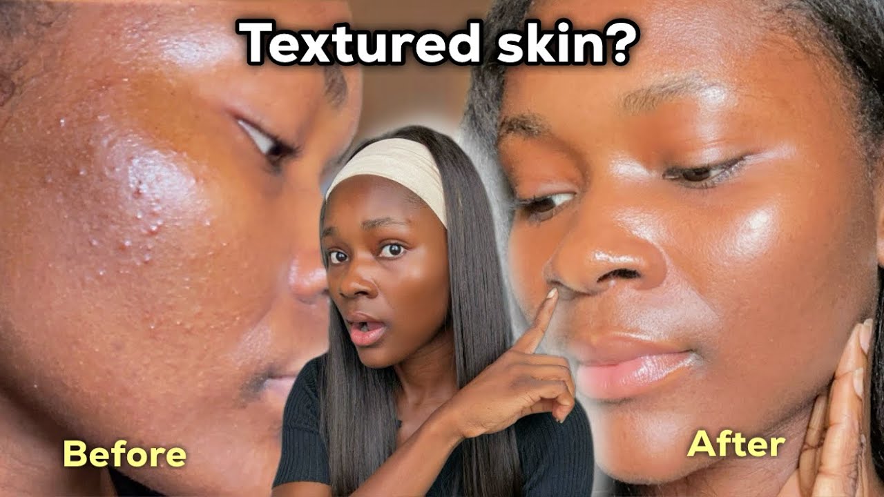 HOW TO GET RID OF TEXTURED SKIN FAST | Clear and smooth skin routine that actually works