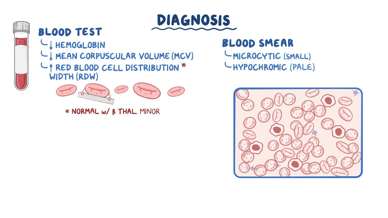 Understanding Beta Thalassemia: Symptoms, Causes & Treatment Options