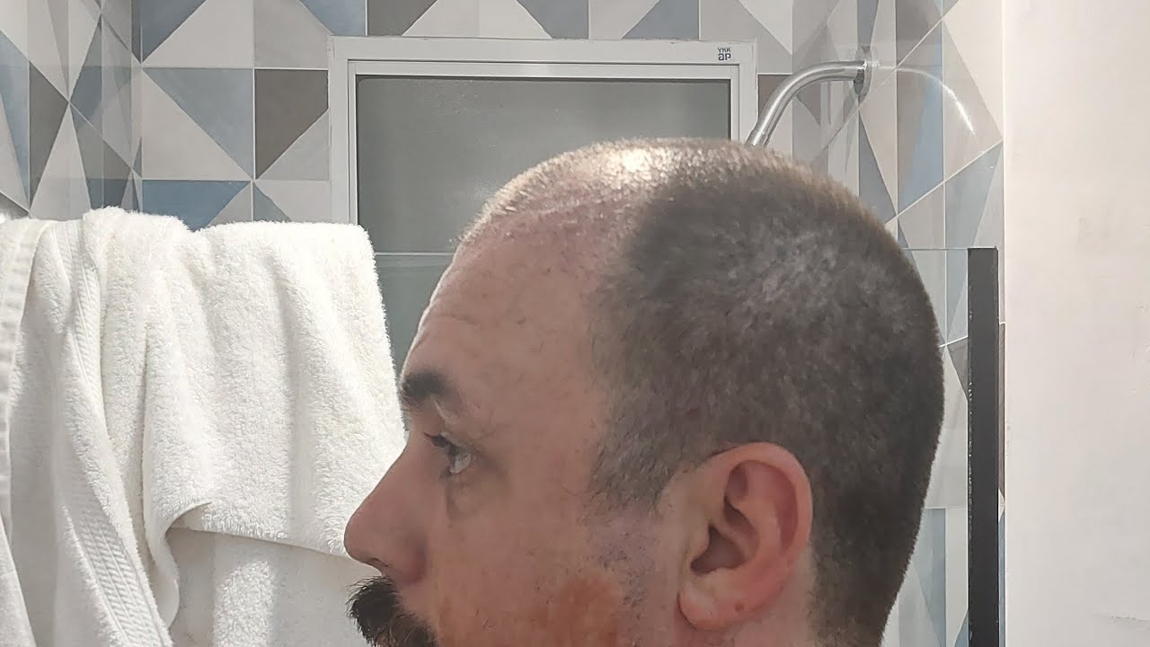 Transplante Capilar - evolução dia a dia, do pós-operatório até os 6 meses. Stanley's Hair 2024