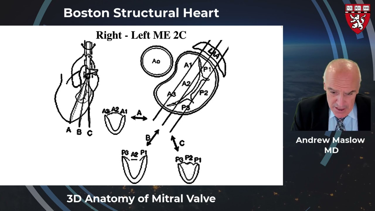 3D Anatomy of the Mitral Valve - Echocardiographic Perspective