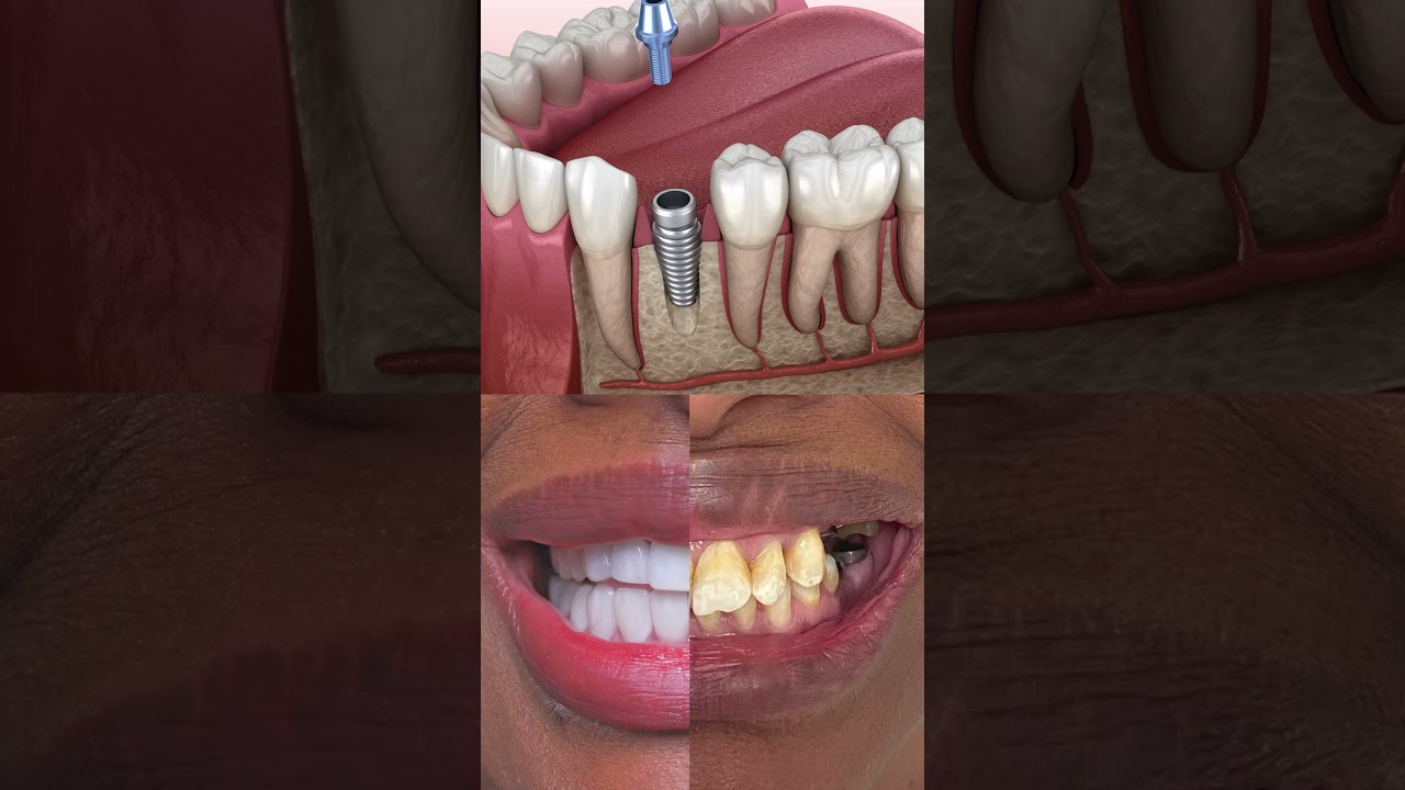 How to Get Dental Implants in Turkey | Step-by-Step Procedure & Real Patient Transformation