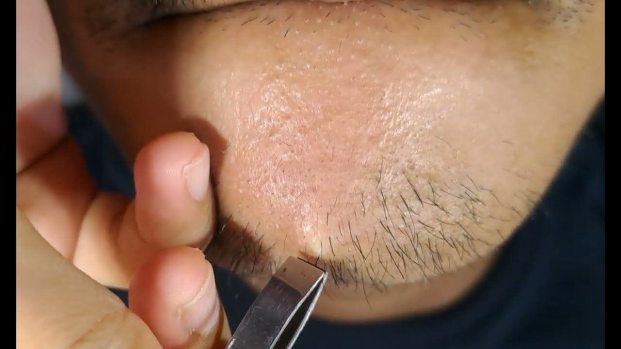 Momen melegakan, kegiatan rutin saat mencabut bulu jenggot #5 #hairremoval #tweezer #satisfying