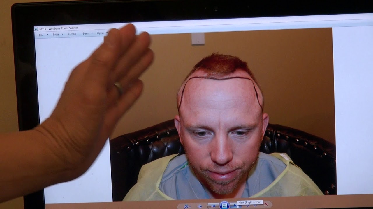 Advance Bald Hair Loss Surgery FUE Hair Transplant San Francisco After Hairline Lowering Dr. Diep