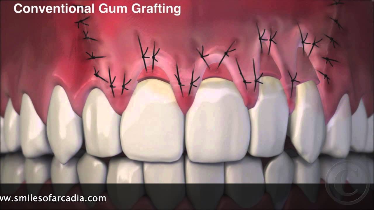 Dr  Peter Young about Pinhole Surgery for treatment receding gums.