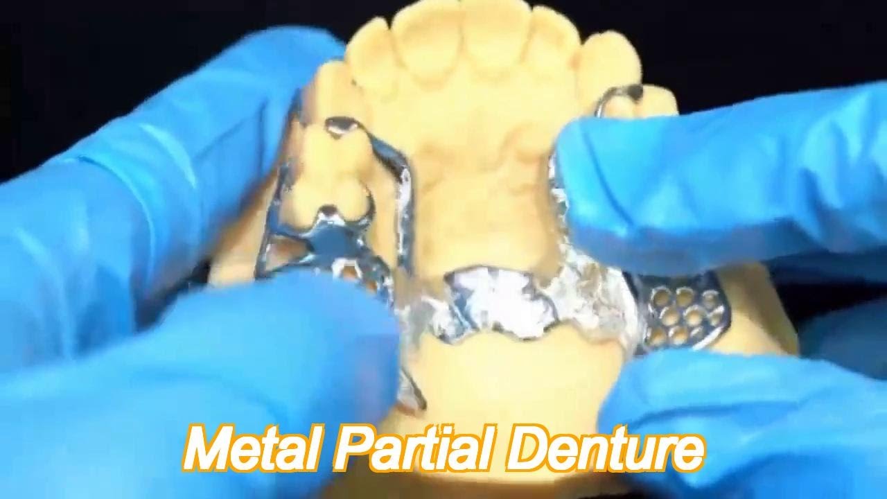 metal alloys partial cobalt chrome dentures ivoclar scheftner comfortable china dental lab