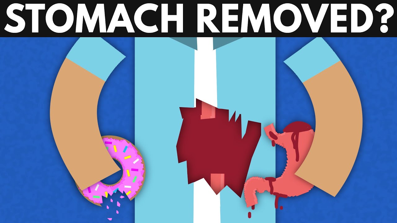What Happens If Your Stomach Gets Removed?