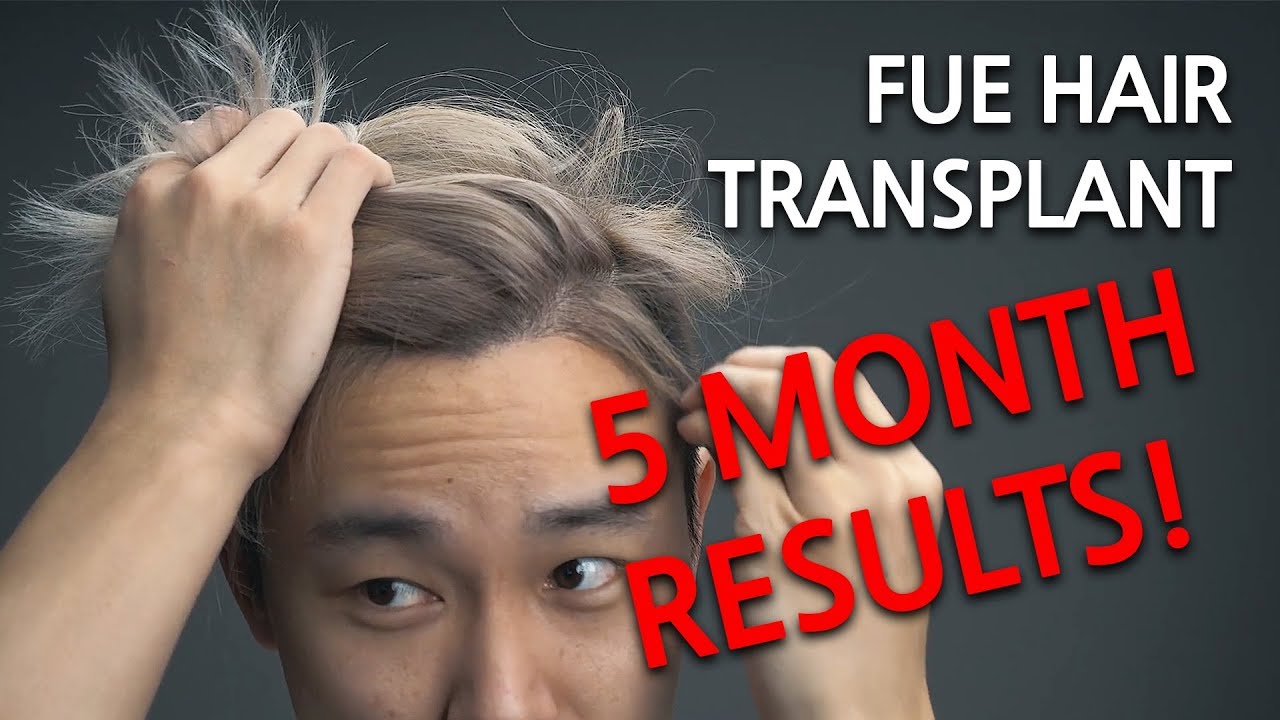 Hair Transplant in KOREA! [Part Two] [5 Month Results Update]