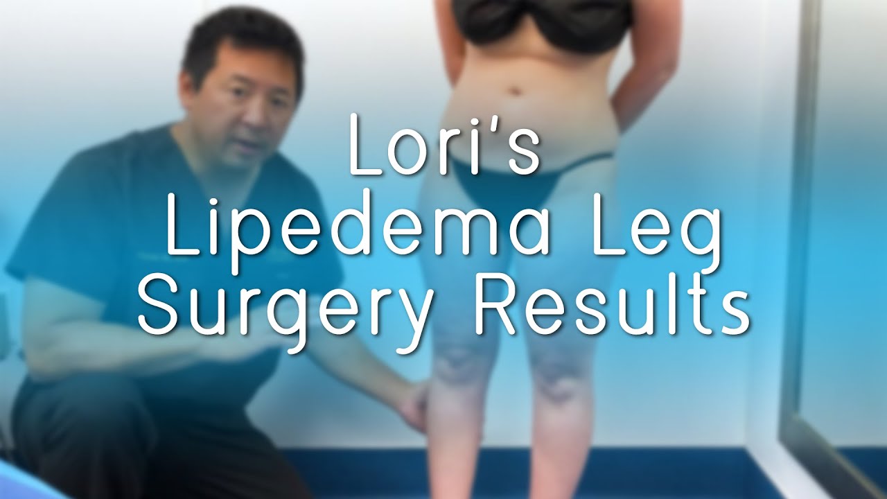 Lipedema Leg Surgery Results | Liposuction | Ankles, Calves, Knees | ArtLipo | Expert Dr. Thomas Su