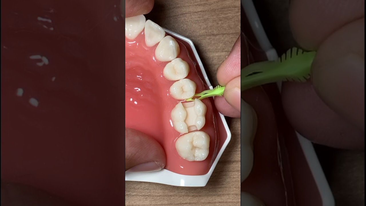 Webinar Live Instagram about first upper molar composite