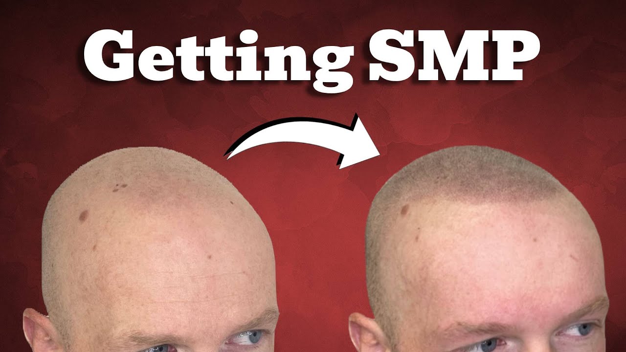 I Got A Hair Tattoo, AKA Scalp Micropigmentation or SMP | Vlog & FAQ