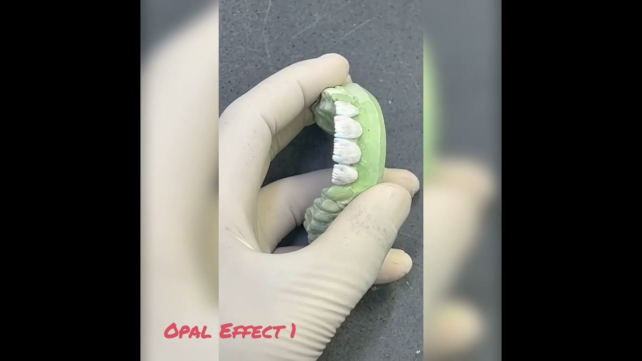 E-Max Veneers Build Up And Finishing