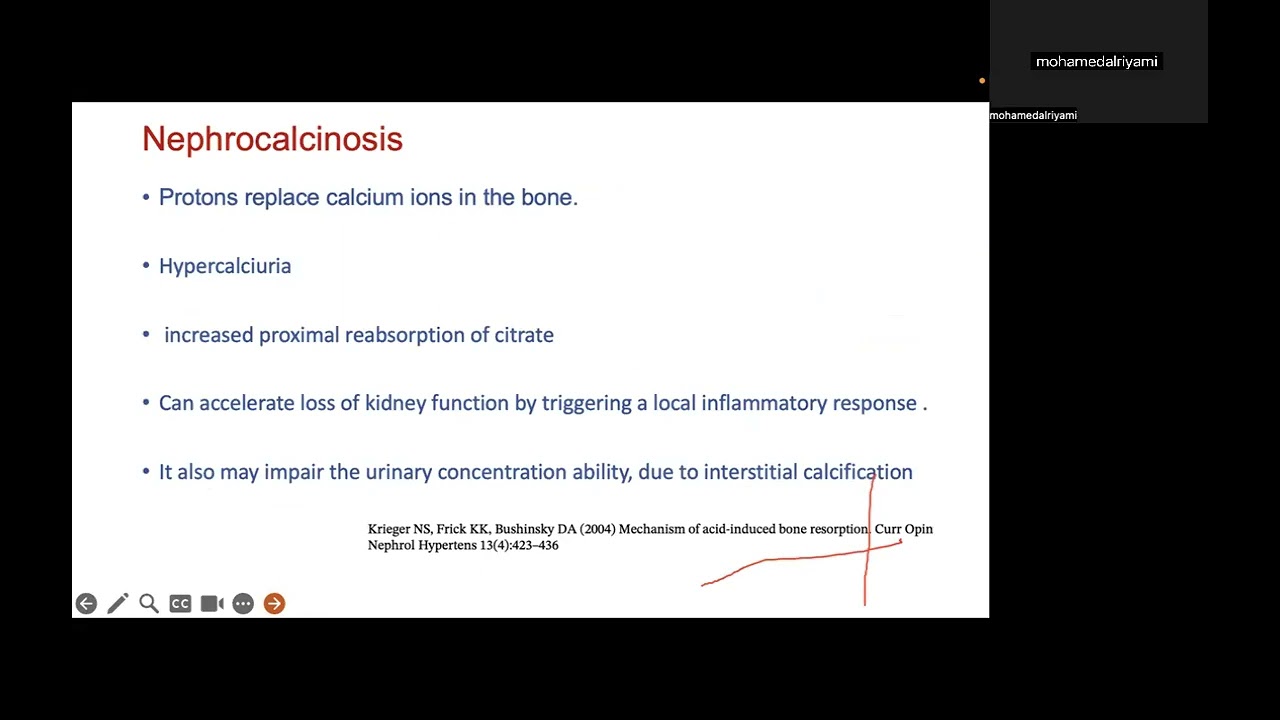 Recent Updates in the Management of Distal Renal Tubular Acidosis dRTA