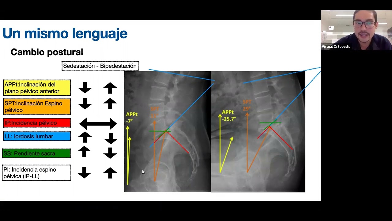 Reemplazo total de cadera y artrodesis lumbar