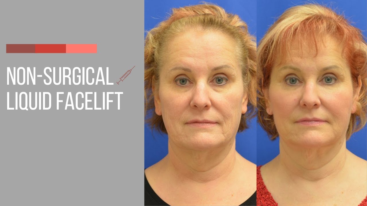 Dr. Normington on Juvederm and Non Surgical Facelifts - Lewisburg Plastic Surgery