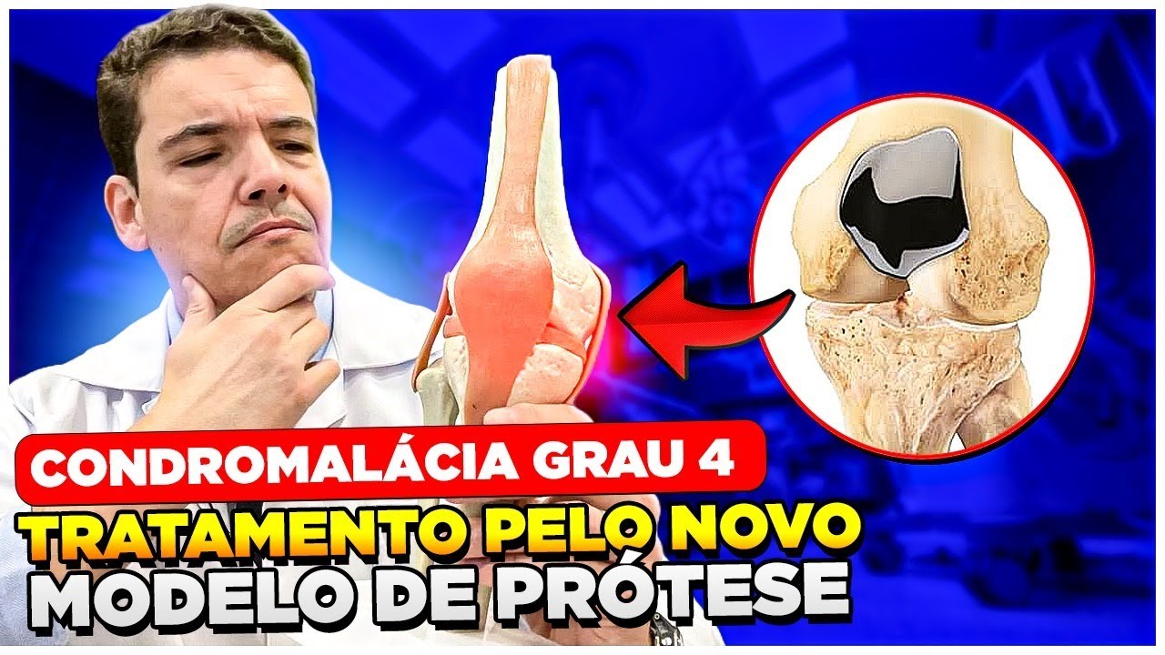 NOVA PRÓTESE DA PATELA PODE SER UMA SOLUÇÃO - Condromalácia