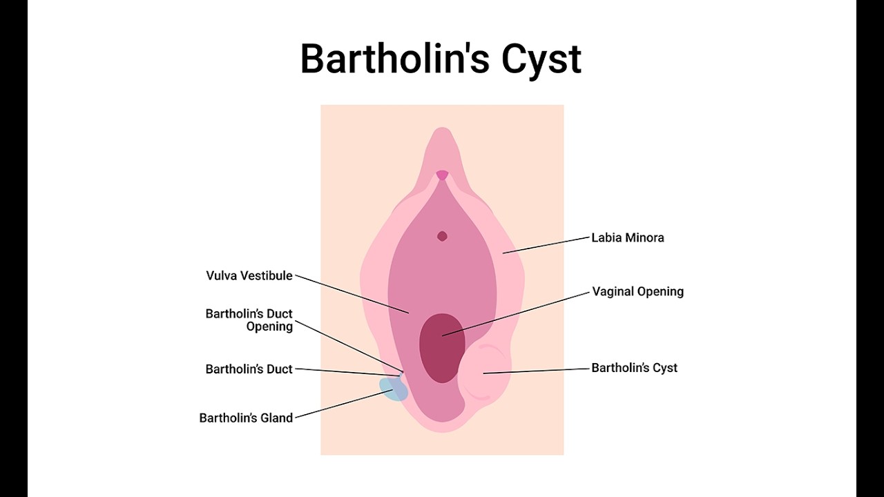Bartholin Gland Cyst (Abscess)