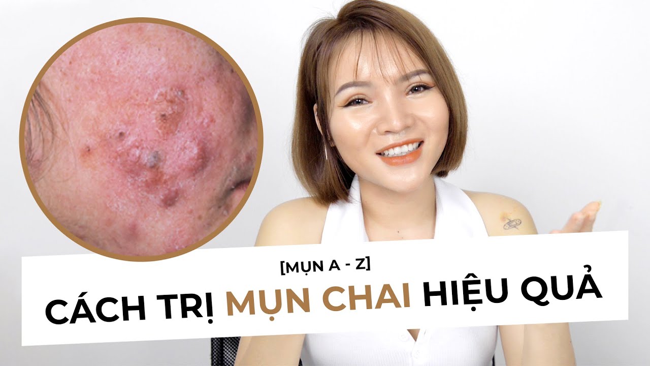 CÁCH XỬ LÝ MỤN CHAI HIỆU QUẢ, AN TOÀN - Chuyện dùng Benzoyl Peroxide, BHA chứa cồn bị chai mụn :(