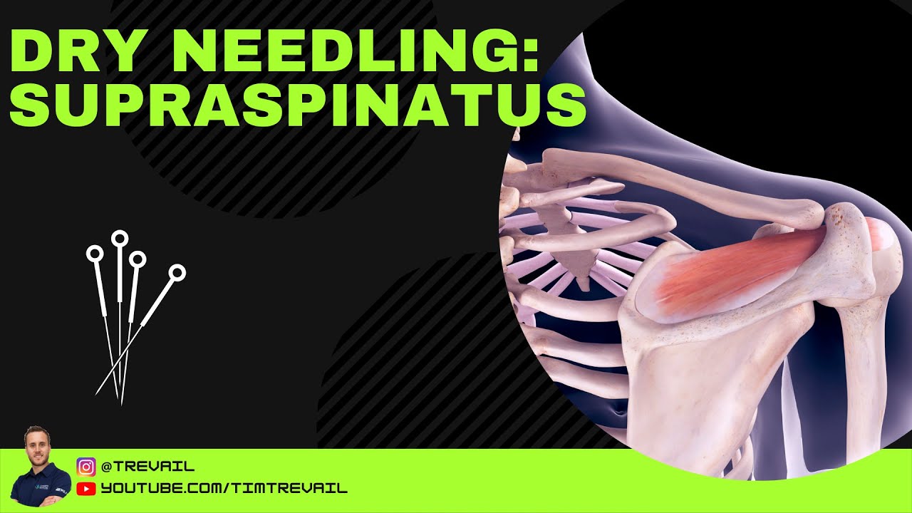 Dry Needling: Supraspinatus