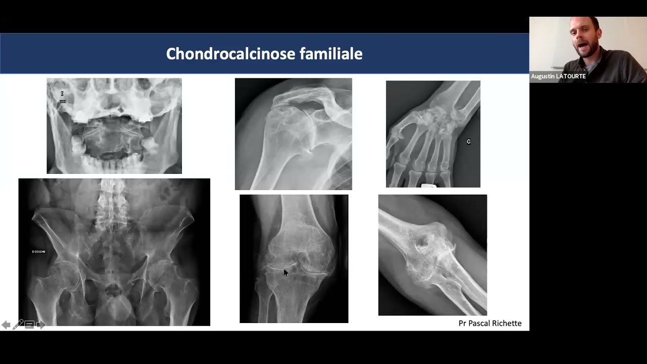 Dr Augustin LATOURTE   La chondrocalcinose   actualités